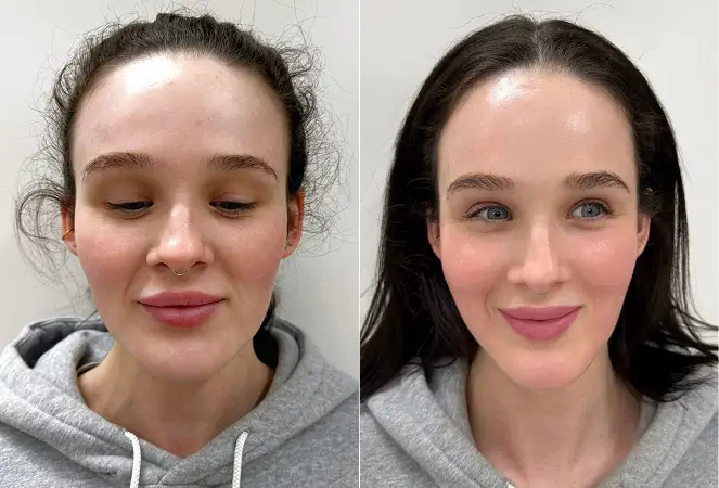 Skin Laser Treatments Melbourne Before & After Results