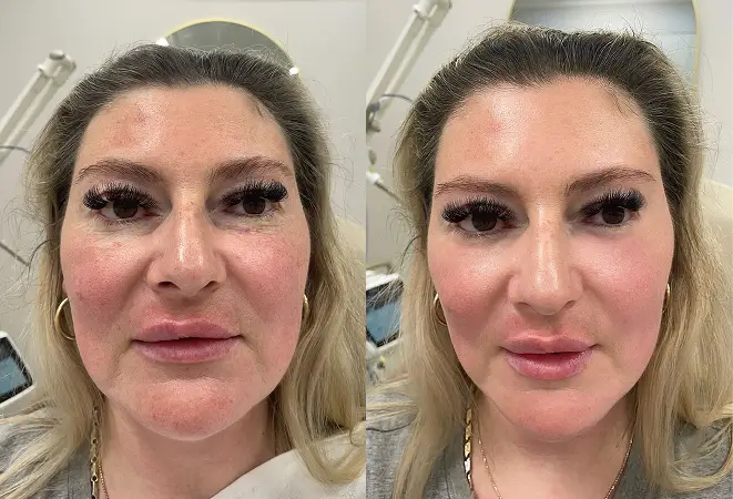 Skin Laser Treatments Melbourne Before and After Photos