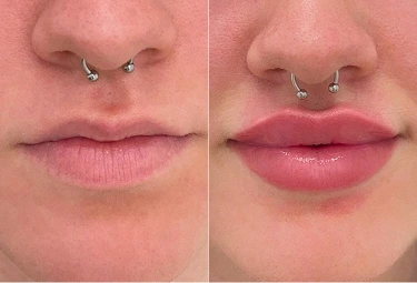 Client with nose piercing showing natural lip enhancement treatment results in Melbourne