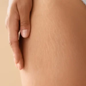 Close-up of atrophic stretch marks on a woman's hip and outer thigh, showing the fine rippled texture typical of mature striae alba, a concern treated at our stretch marks Melbourne clinic