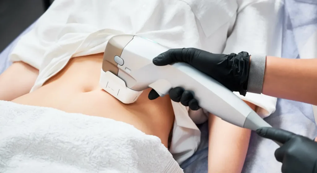 Clinician using a laser device on a woman's stomach during a professional skin treatment, the kind of laser therapy for stretch marks our Melbourne clinic offers