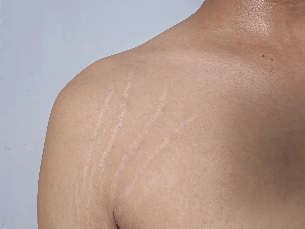 Stretch marks on the shoulder and back showing pale linear scarring across the skin. Our Melbourne clinic offers treatments to help reduce their appearance