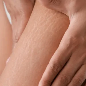 Visible stretch marks on the inner upper arm and armpit, a less commonly shown but very real concern that our stretch marks Melbourne team regularly treats