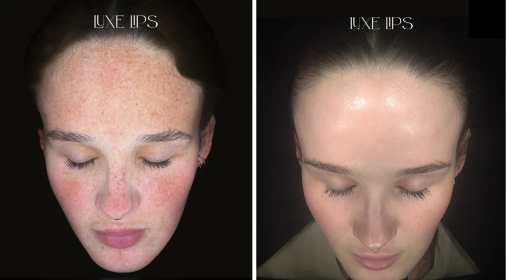 Before and after skin results showing reduced freckles and smoother complexion with Picosure laser packages
