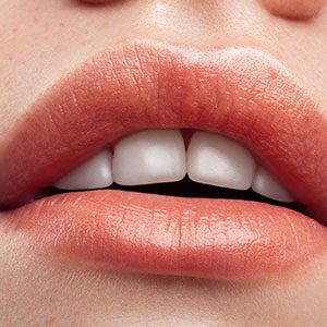 lip enhancement results from Luxe Lips