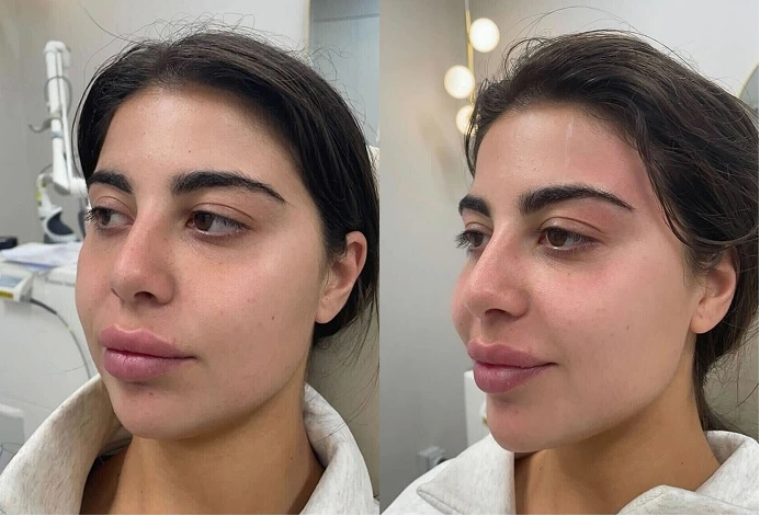 Before and after facial rejuvenation treatment at Luxe Lips showing improved skin tone and contour.
