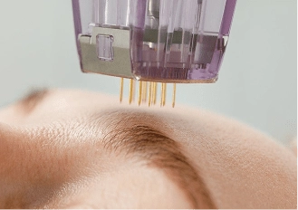 exosomes skin needling treatment with microneedling device on skin
