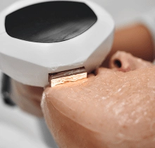 Laser skin treatments at Luxe Lips Melbourne