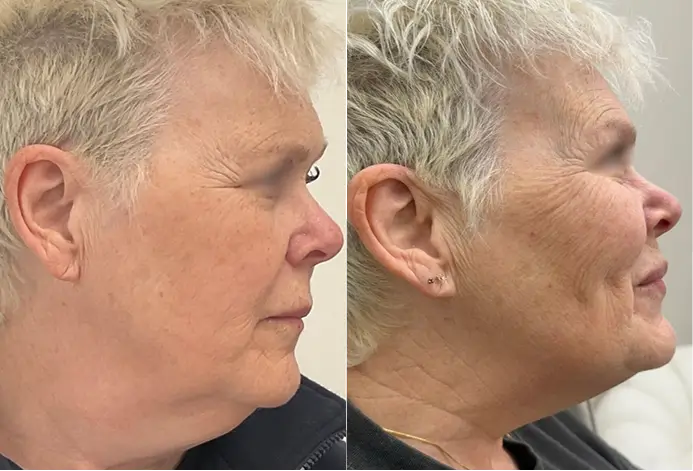 A side-by-side comparison illustrating a noticeable difference in jawline contour and lower facial skin appearance, often seen following supportive skin revitalisation procedures.