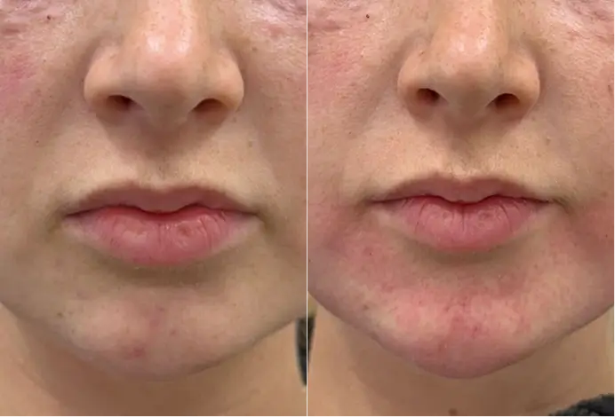 A before-and-after visualization of the mouth area demonstrating subtle improvement in the appearance of skin smoothness, texture, and lip-area volume.