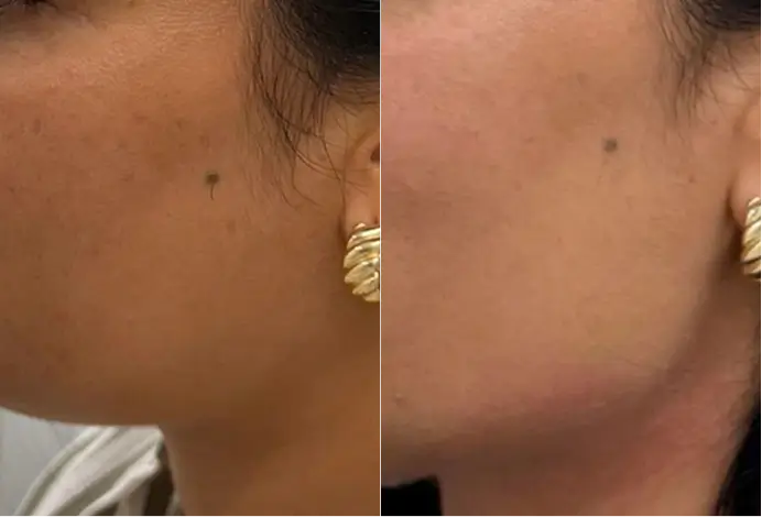 A split-screen comparison focusing on a reduction in the visible appearance of skin pigment and unevenness, alongside a subtle refresh of cheek contour.