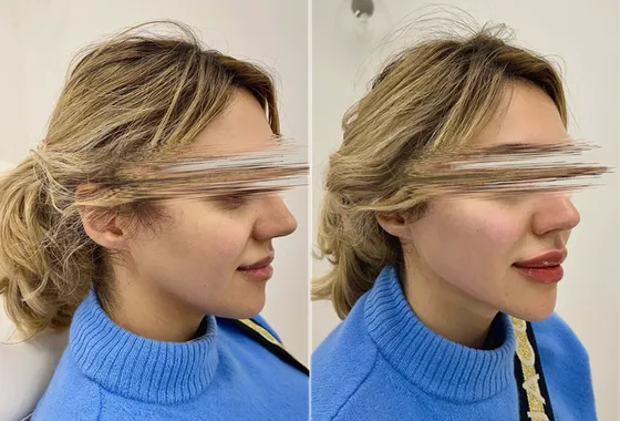 Woman with a refined side profile after treatment at a cosmetic clinic in Melbourne.