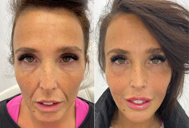 BeforeAndAfterSetNewE