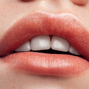 lip enhancement results from Luxe Lips