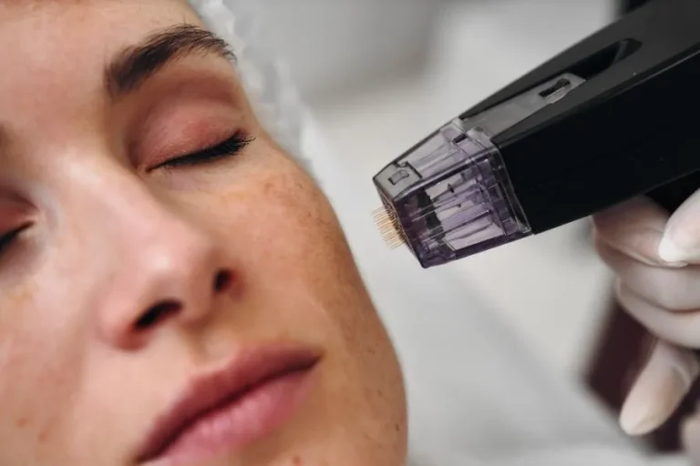 Radiofrequency microneedling handpiece held close to a client's cheek during treatment