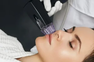 A clinical close-up of a patient receiving a treatment to illustrate what is Morpheus8, showing the microneedling radiofrequency device being applied to the cheek area.