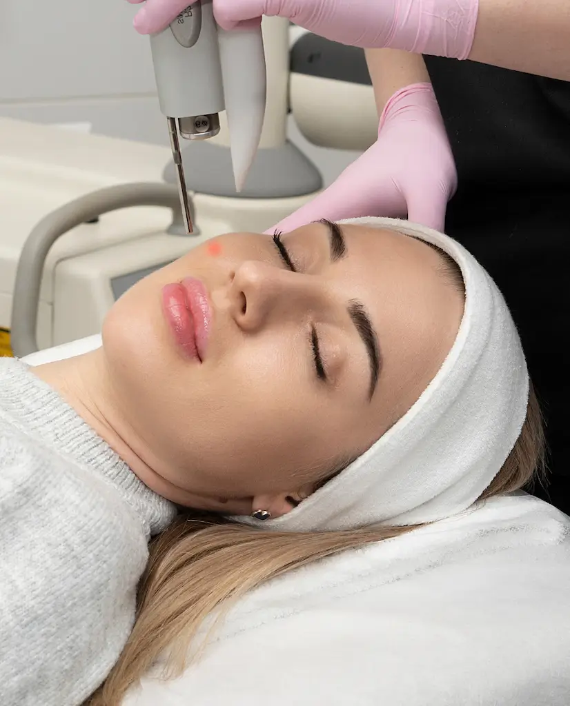 Acne Scar Revision with Fotona