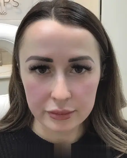 Consultation for Fine Lines & Wrinkles