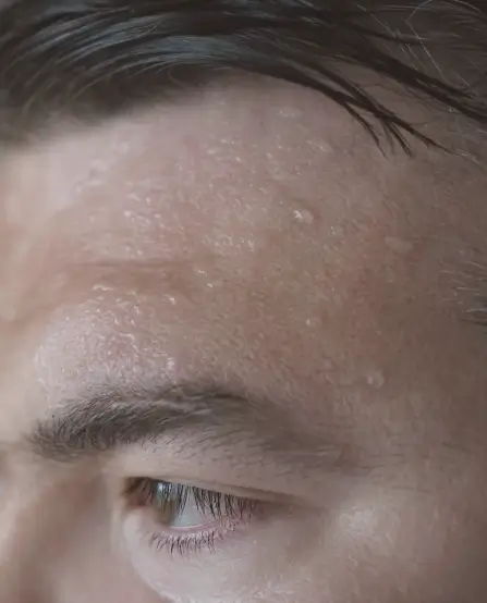 Excessive Sweating (Hyperhidrosis) – Type B