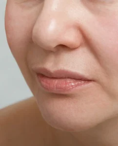 Close-up of a woman's mouth and cheek for nasolabial fold treatment in Melbourne