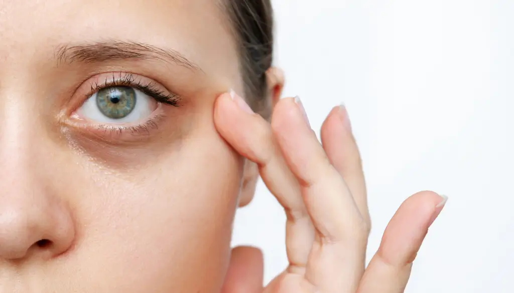 Under-Eye Shadowing or “Dark” Appearance (Cause-Based Planning)