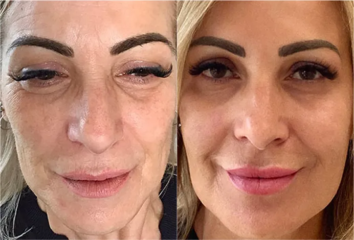 Before and after comparison of a patient at Luxe Lips showing a more youthful and balanced appearance.