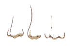 Nose asymmetry illustration showing differences in nasal shape and alignment
