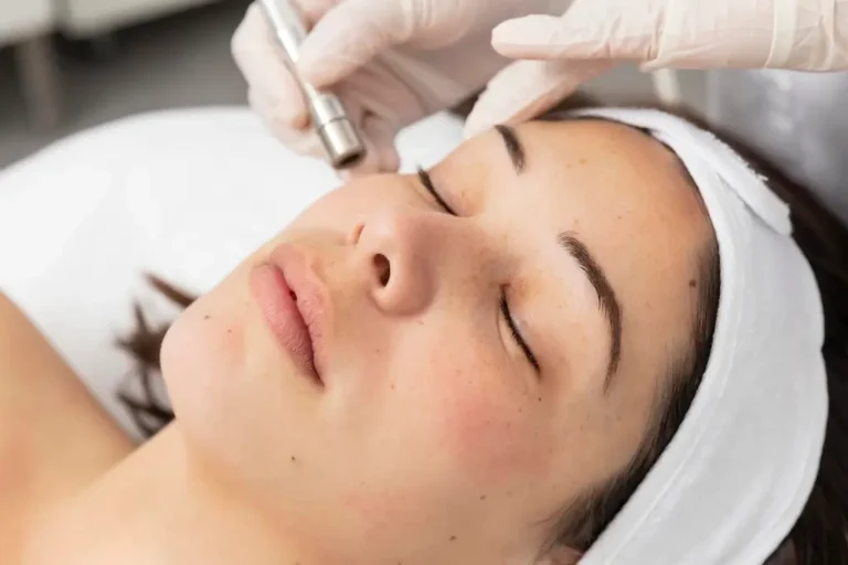 A Luxe Lips patient receiving an exosomes microneedling treatment to improve skin texture and health.