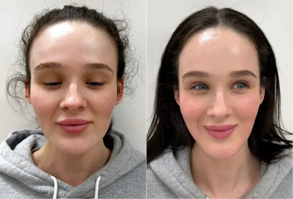 Front facing facial images used in a clinical consultation to discuss Fotona skin laser treatment in Melbourne