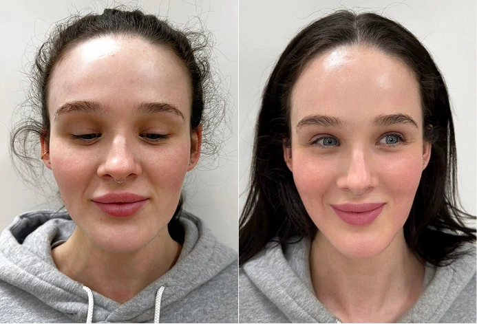 Side-by-side comparison of facial features before and after a Luxe Lips cosmetic enhancement.