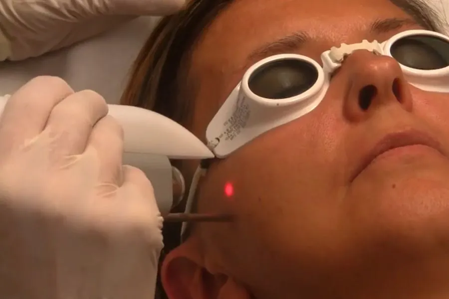 Clinical application of Fotona 5D laser for skin tightening and rejuvenation.