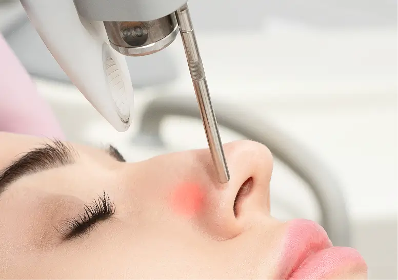Clinician performing Fotona laser treatment for skin tightening in Melbourne cosmetic clinic