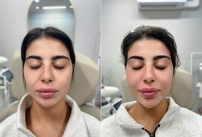 Laser Skin Rejuvenation at Luxe Lips Cosmetic Clinic Melbourne