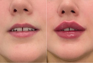 Young woman showing fuller lips after lip enhancement treatment in Melbourne