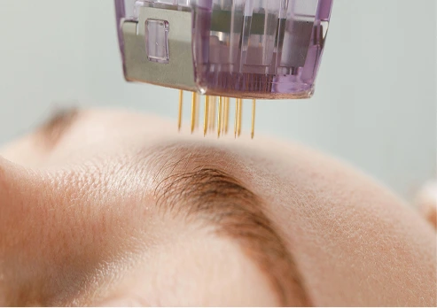 Skin needling device performing microneedling treatment for skin rejuvenation in Melbourne