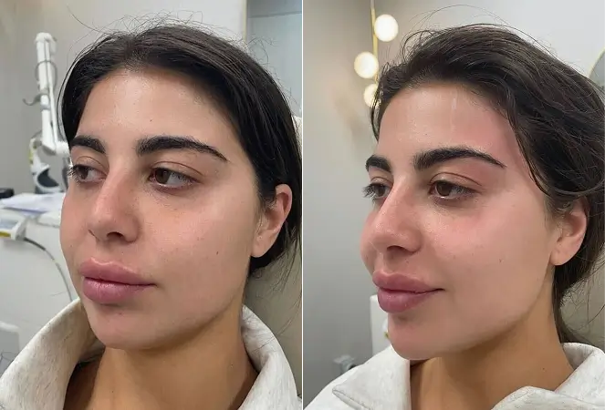 Skin Laser Treatments Melbourne Before and After