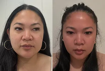 Comparison of facial aesthetic results before and after a procedure at Luxe Lips.