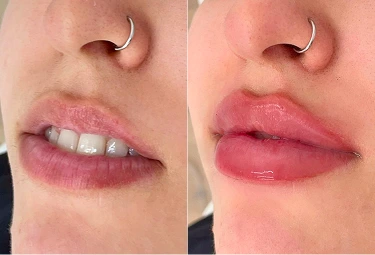 Close up before and after lips with nose ring following lip enhancement treatment in Melbourne