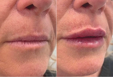 Before and after comparison of subtle lip enhancement treatment in Melbourne
