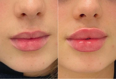 Close up before and after results of lip enhancement treatment in Melbourne