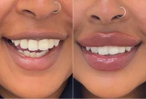 Smiling client showing fuller lips after lip enhancement treatment in Melbourne