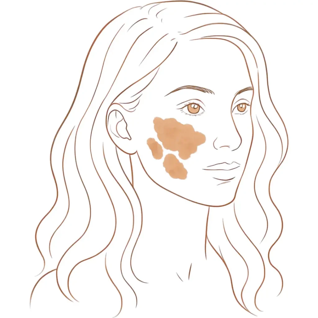 Illustration showing melasma-related pigmentation across the cheek area