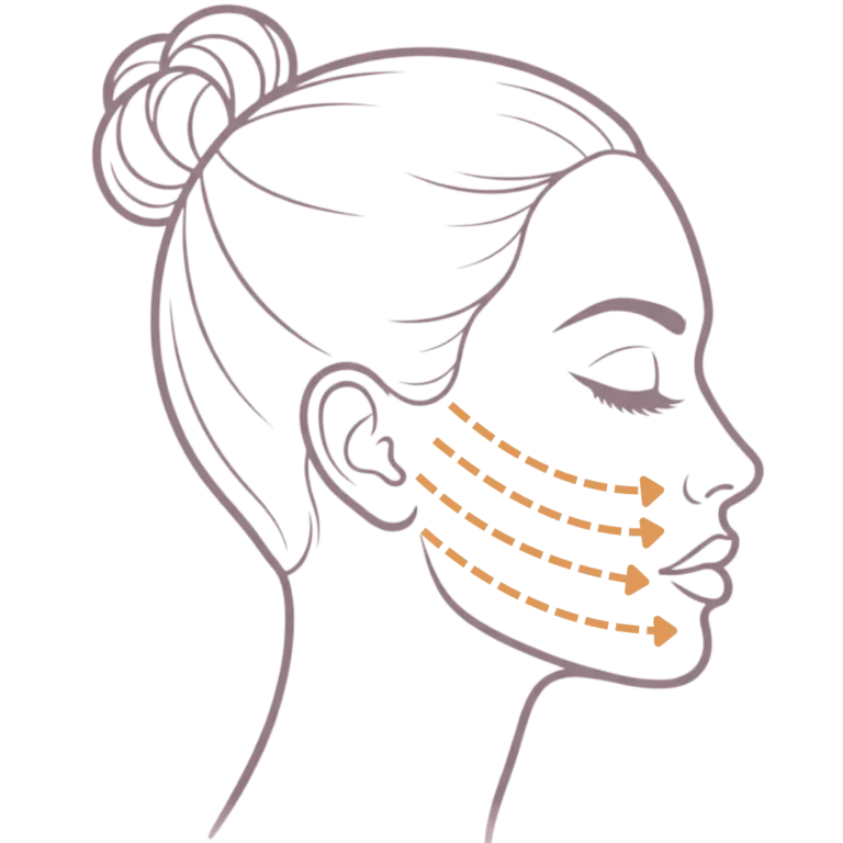 Illustration showing reduced facial support in the cheek area