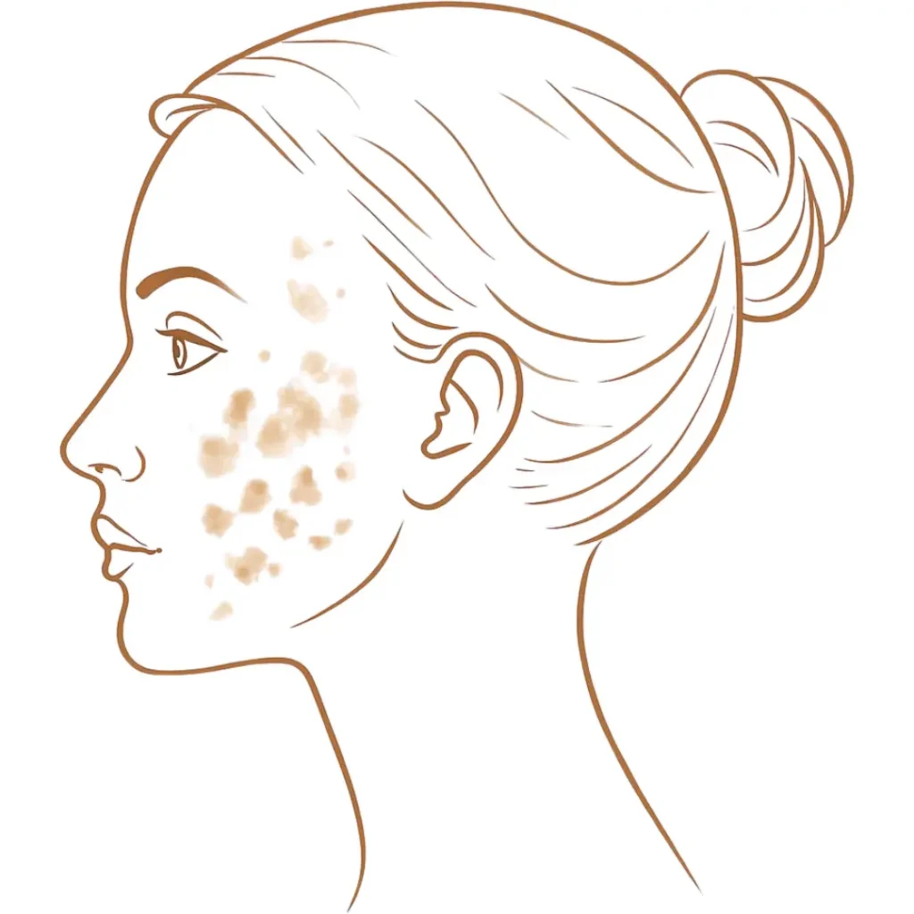 Illustration of post inflammatory pigmentation marks left after acne breakouts