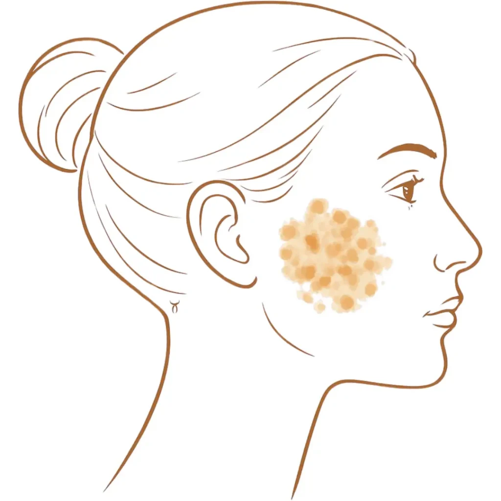 Illustration showing sun-related pigmentation caused by cumulative UV exposure