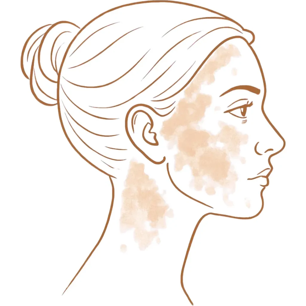 Illustration showing uneven skin tone with irregular pigmentation patches