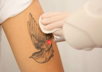 PicoSure laser tattoo removal treatment on a bird tattoo at Luxe Lips clinic.