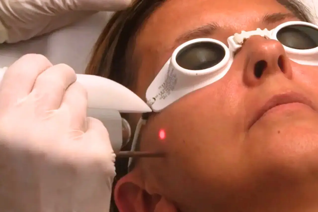 Practitioner performing Fotona 5D laser facial treatment on patient wearing protective goggles, a non-surgical skin tightening and rejuvenation procedure