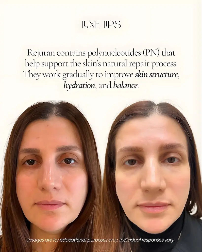 Before and after comparison showing rejuran benefits with smoother skin texture, improved hydration, and balanced complexion