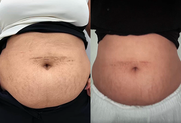Before and after comparison of the abdomen area, showing a visible reduction in stretch marks and improved skin tightness through personalized treatments.